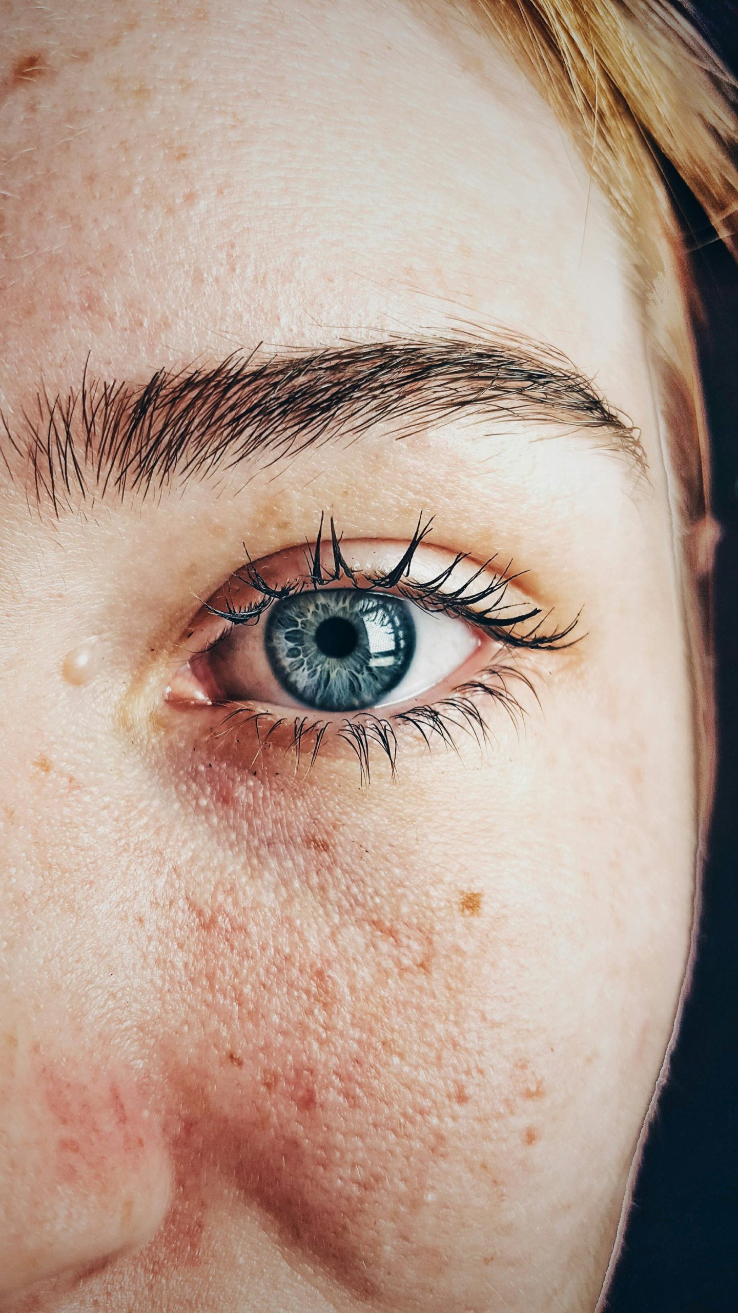 Acupuncture for Acne